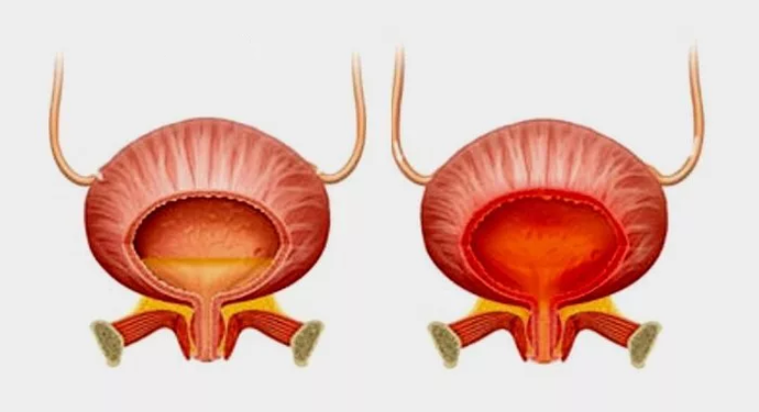 Normální močový měchýř (vlevo) a zánět močového měchýře s cystitidou (vpravo)